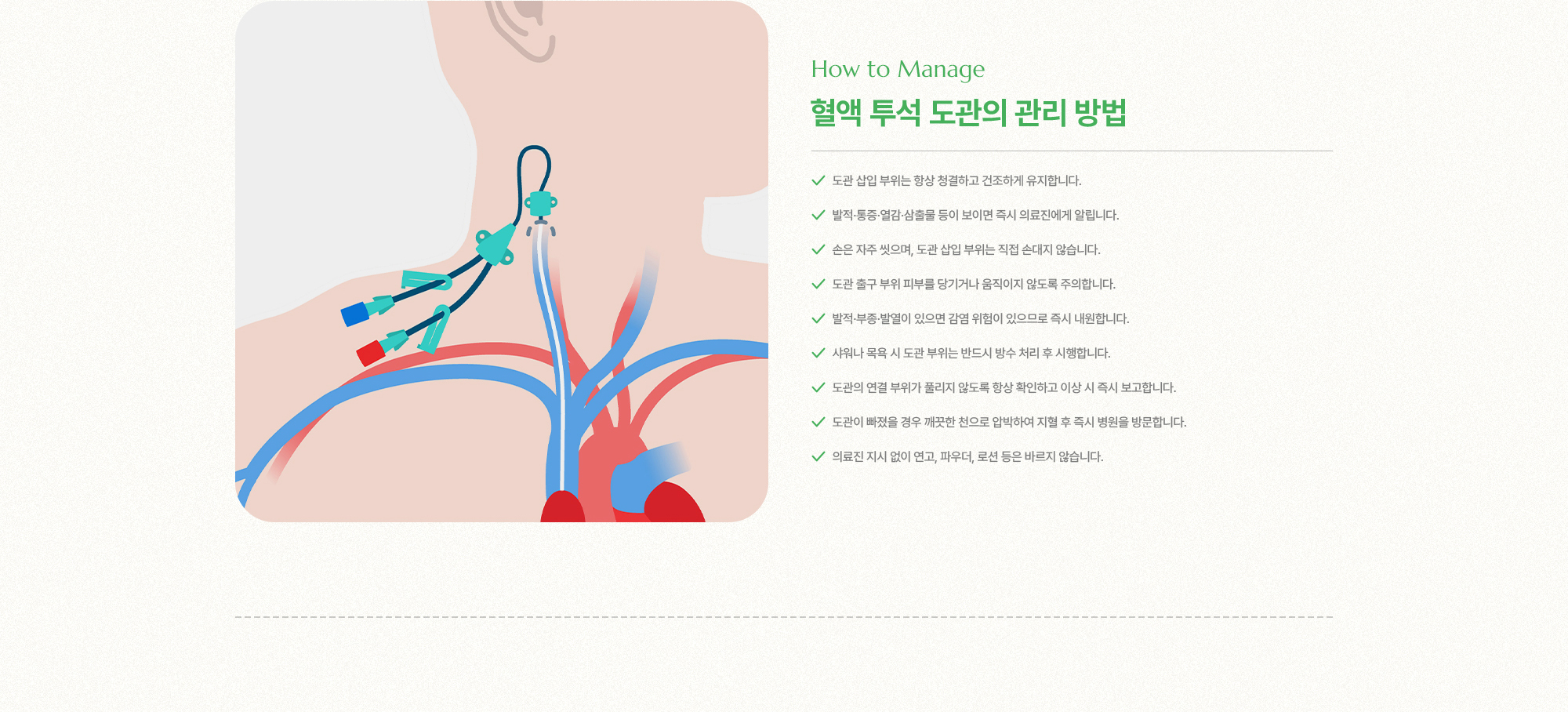 혈액 투석 도관의 관리 방법 | 도관 삽입 부위는 항상 청결하고 건조하게 유지합니다, 발적·통증·열감·삼출물 등이 보이면 즉시 의료진에게 알립니다, 손은 자주 씻으며, 도관 삽입 부위는 직접 손대지 않습니다.